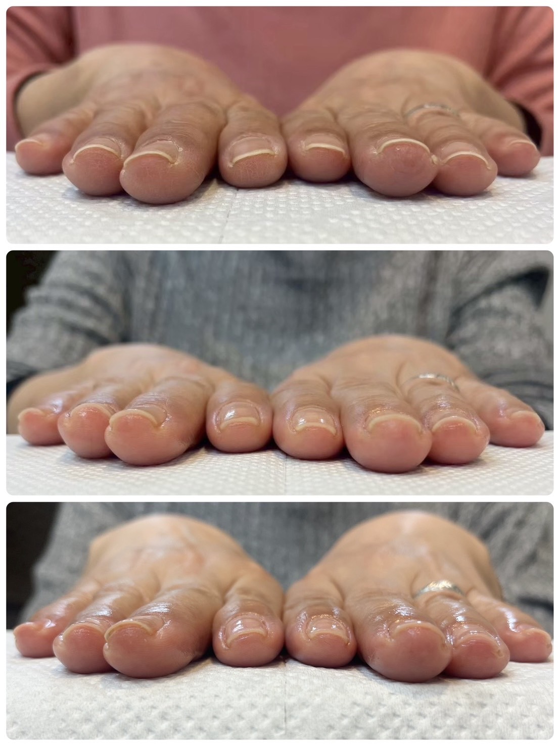 自爪育成 ビフォーアフター
